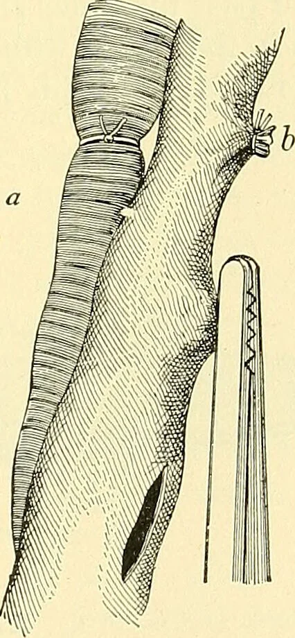 An illustration from Modern surgery, general and operative / by John Chalmers Da Costa., 1907, leaf 385
