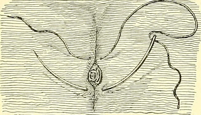 An illustration from Modern surgery, general and operative / by John Chalmers Da Costa., 1907, leaf 386