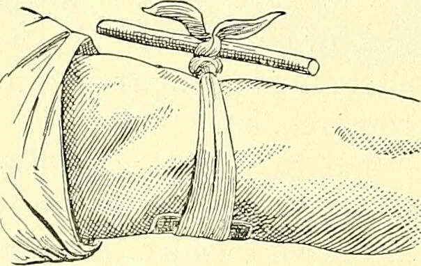 An illustration from Modern surgery, general and operative / by John Chalmers Da Costa., 1907, leaf 388