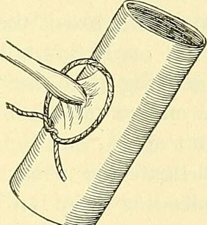 An illustration from Modern surgery, general and operative / by John Chalmers Da Costa., 1907, leaf 393