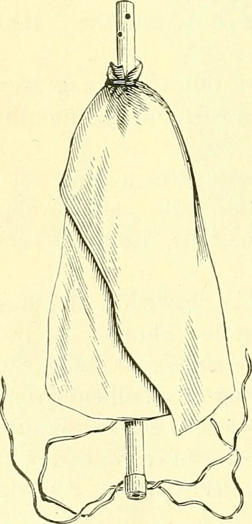 An illustration from Modern surgery, general and operative / by John Chalmers Da Costa., 1907, leaf 398