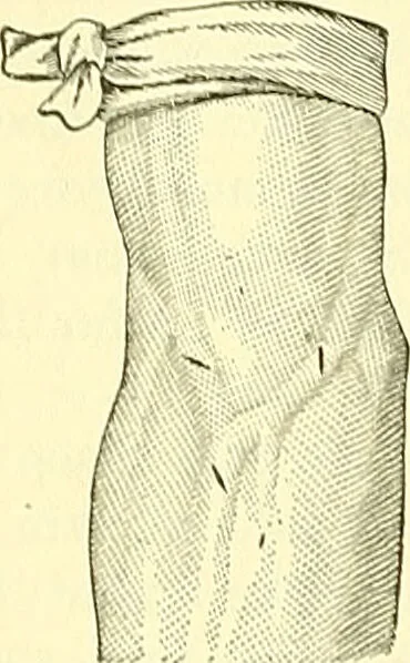 An illustration from Modern surgery, general and operative / by John Chalmers Da Costa., 1907, leaf 404