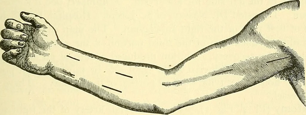 An illustration from Modern surgery, general and operative / by John Chalmers Da Costa., 1907, leaf 419