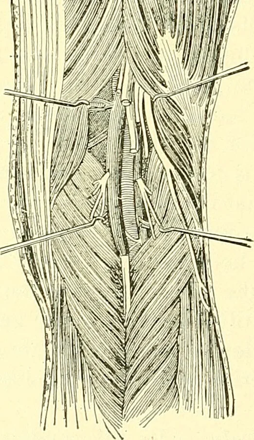An illustration from Modern surgery, general and operative / by John Chalmers Da Costa., 1907, leaf 436