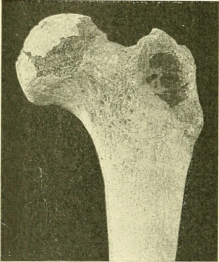 An illustration from Modern surgery, general and operative / by John Chalmers Da Costa., 1907, leaf 448