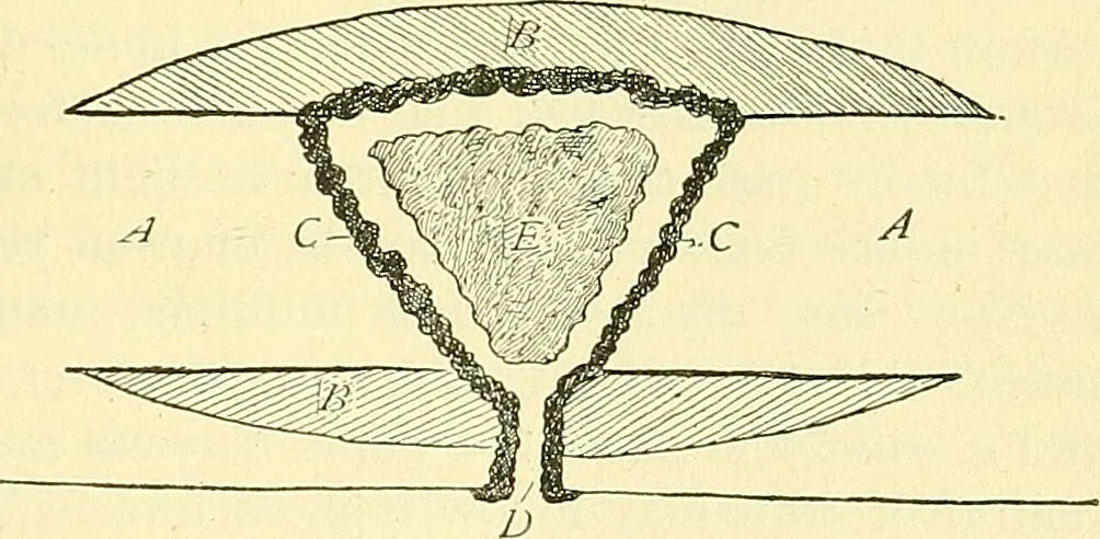 An illustration from Modern surgery, general and operative / by John Chalmers Da Costa., 1907, leaf 451