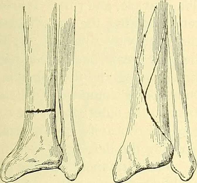 An illustration from Modern surgery, general and operative / by John Chalmers Da Costa., 1907, leaf 461