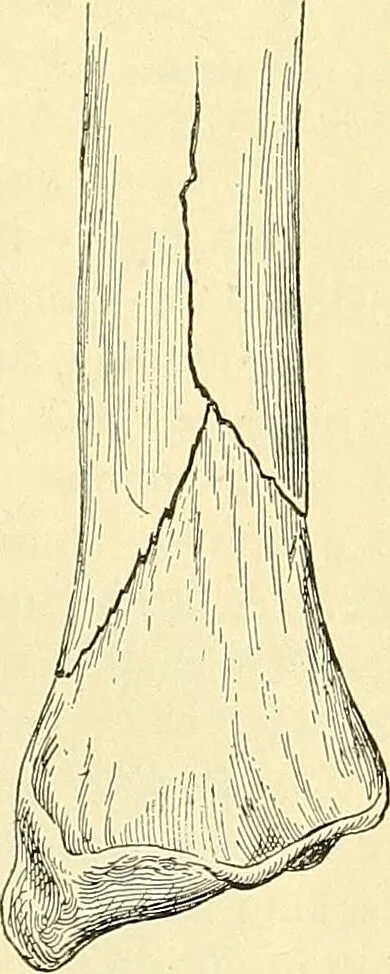 An illustration from Modern surgery, general and operative / by John Chalmers Da Costa., 1907, leaf 461