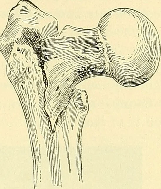An illustration from Modern surgery, general and operative / by John Chalmers Da Costa., 1907, leaf 463