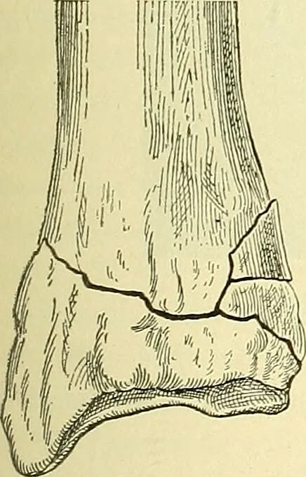 An illustration from Modern surgery, general and operative / by John Chalmers Da Costa., 1907, leaf 463