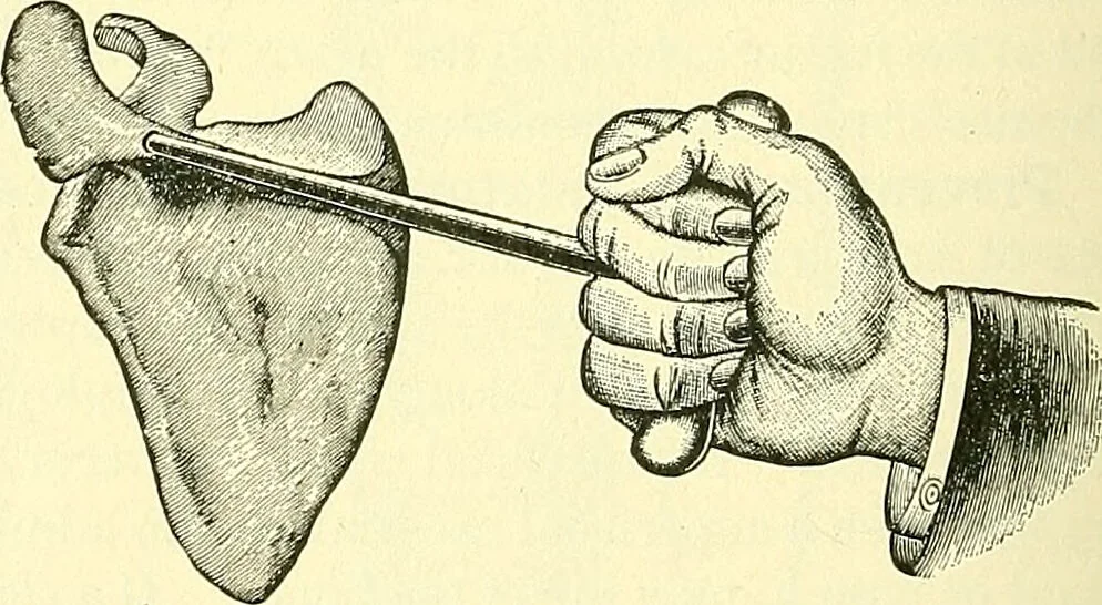 An illustration from Modern surgery, general and operative / by John Chalmers Da Costa., 1907, leaf 478