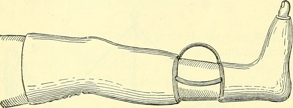 An illustration from Modern surgery, general and operative / by John Chalmers Da Costa., 1907, leaf 480