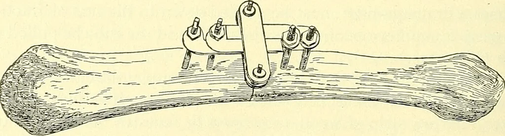An illustration from Modern surgery, general and operative / by John Chalmers Da Costa., 1907, leaf 480