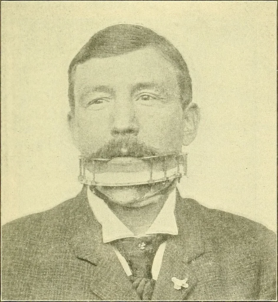 An illustration from Modern surgery, general and operative / by John Chalmers Da Costa., 1907, leaf 485