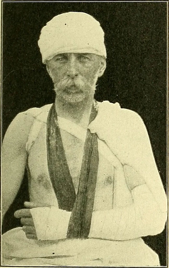 An illustration from Modern surgery, general and operative / by John Chalmers Da Costa., 1907, leaf 503