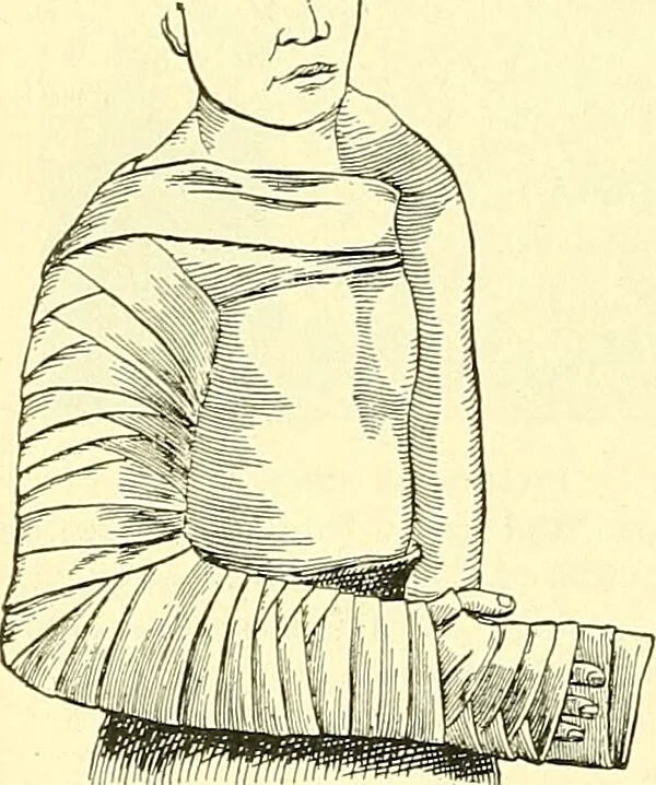 An illustration from Modern surgery, general and operative / by John Chalmers Da Costa., 1907, leaf 504
