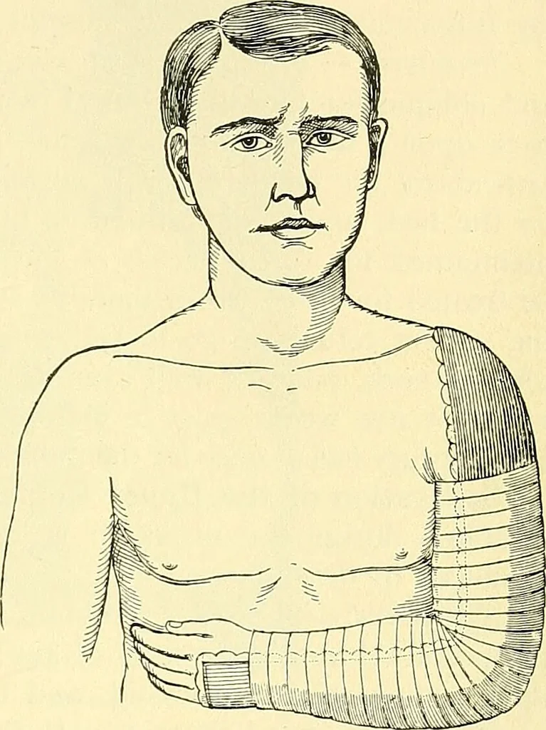 An illustration from Modern surgery, general and operative / by John Chalmers Da Costa., 1907, leaf 505