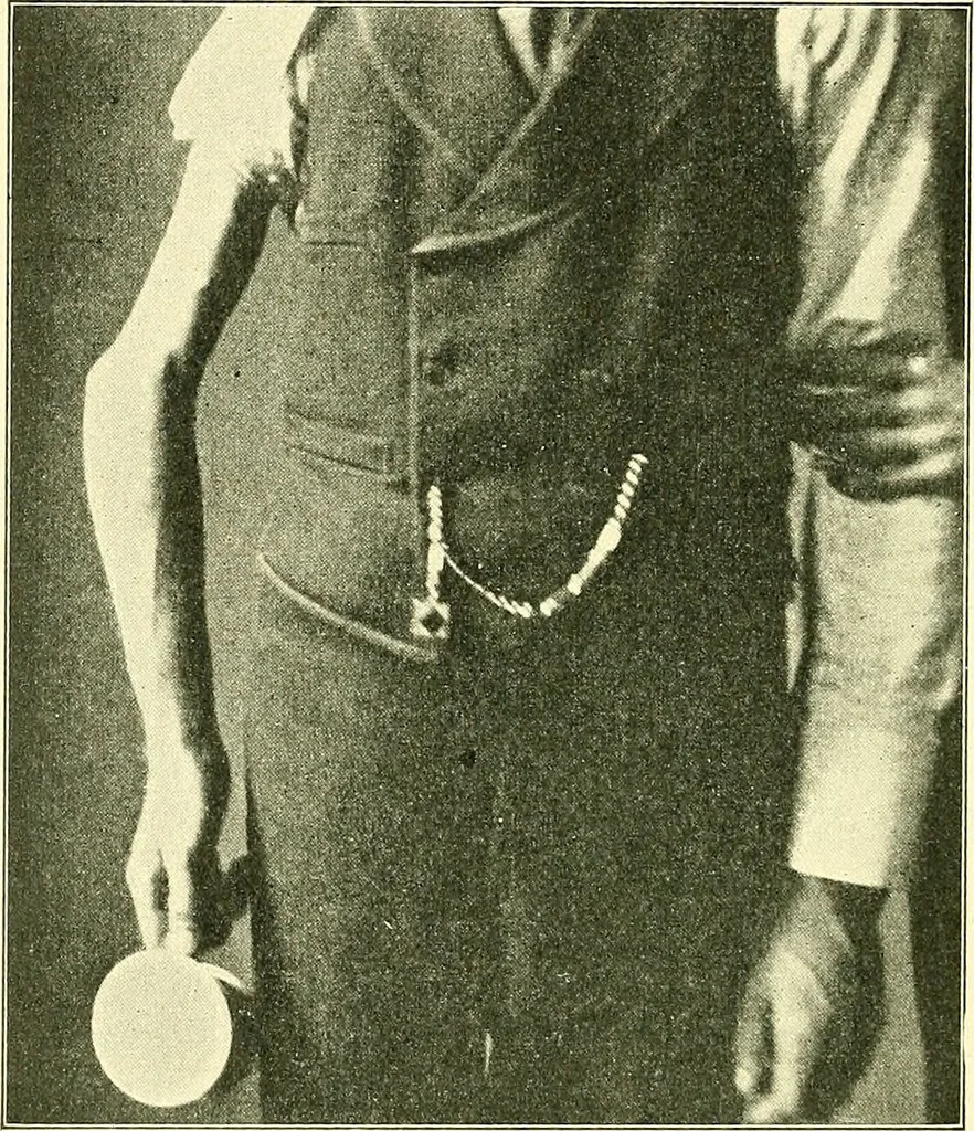 An illustration from Modern surgery, general and operative / by John Chalmers Da Costa., 1907, leaf 510