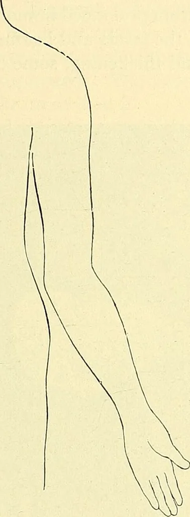 An illustration from Modern surgery, general and operative / by John Chalmers Da Costa., 1907, leaf 511