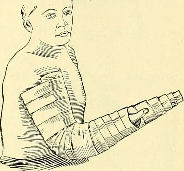 An illustration from Modern surgery, general and operative / by John Chalmers Da Costa., 1907, leaf 513