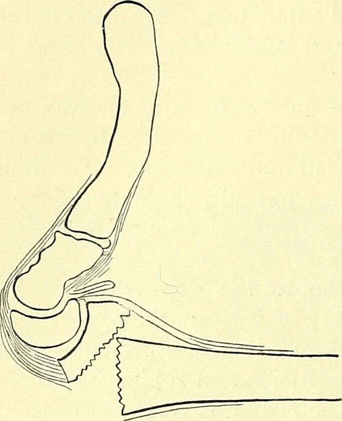 An illustration from Modern surgery, general and operative / by John Chalmers Da Costa., 1907, leaf 522