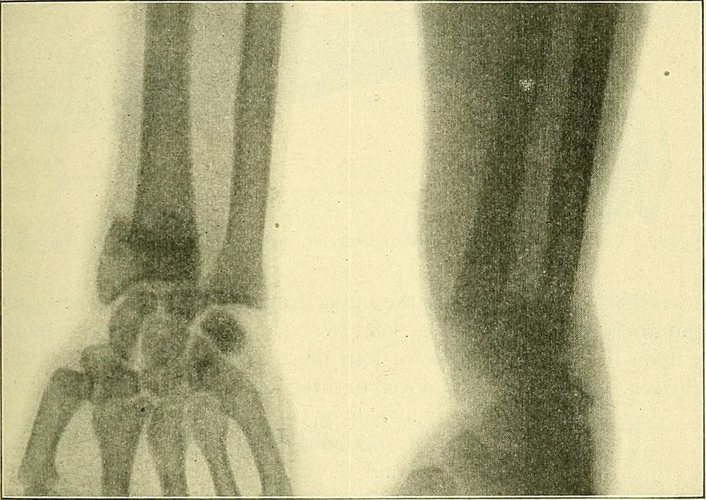 An illustration from Modern surgery, general and operative / by John Chalmers Da Costa., 1907, leaf 523
