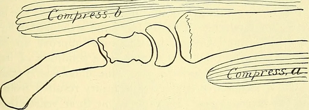 An illustration from Modern surgery, general and operative / by John Chalmers Da Costa., 1907, leaf 525