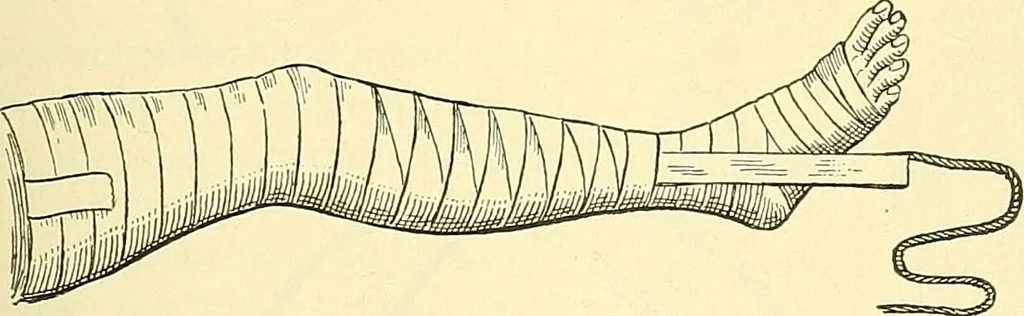 An illustration from Modern surgery, general and operative / by John Chalmers Da Costa., 1907, leaf 533