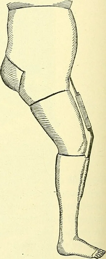 An illustration from Modern surgery, general and operative / by John Chalmers Da Costa., 1907, leaf 544