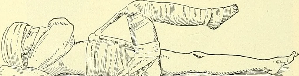 An illustration from Modern surgery, general and operative / by John Chalmers Da Costa., 1907, leaf 546