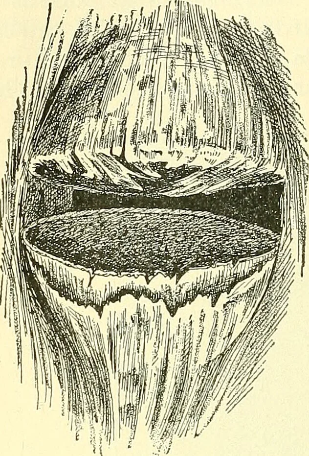 An illustration from Modern surgery, general and operative / by John Chalmers Da Costa., 1907, leaf 550