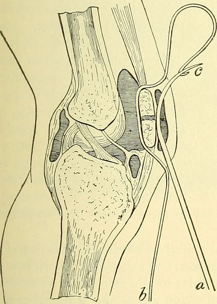 An illustration from Modern surgery, general and operative / by John Chalmers Da Costa., 1907, leaf 551