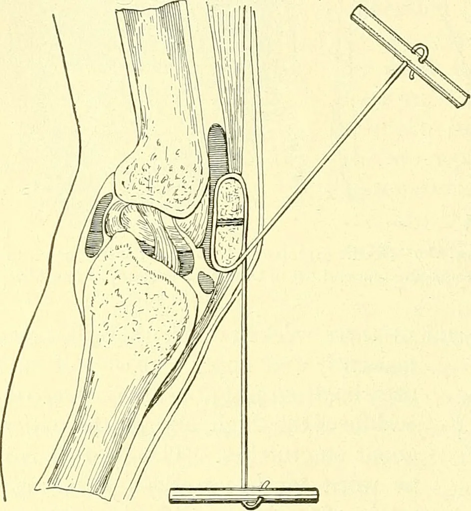 An illustration from Modern surgery, general and operative / by John Chalmers Da Costa., 1907, leaf 552