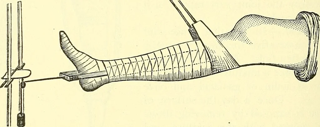 An illustration from Modern surgery, general and operative / by John Chalmers Da Costa., 1907, leaf 578