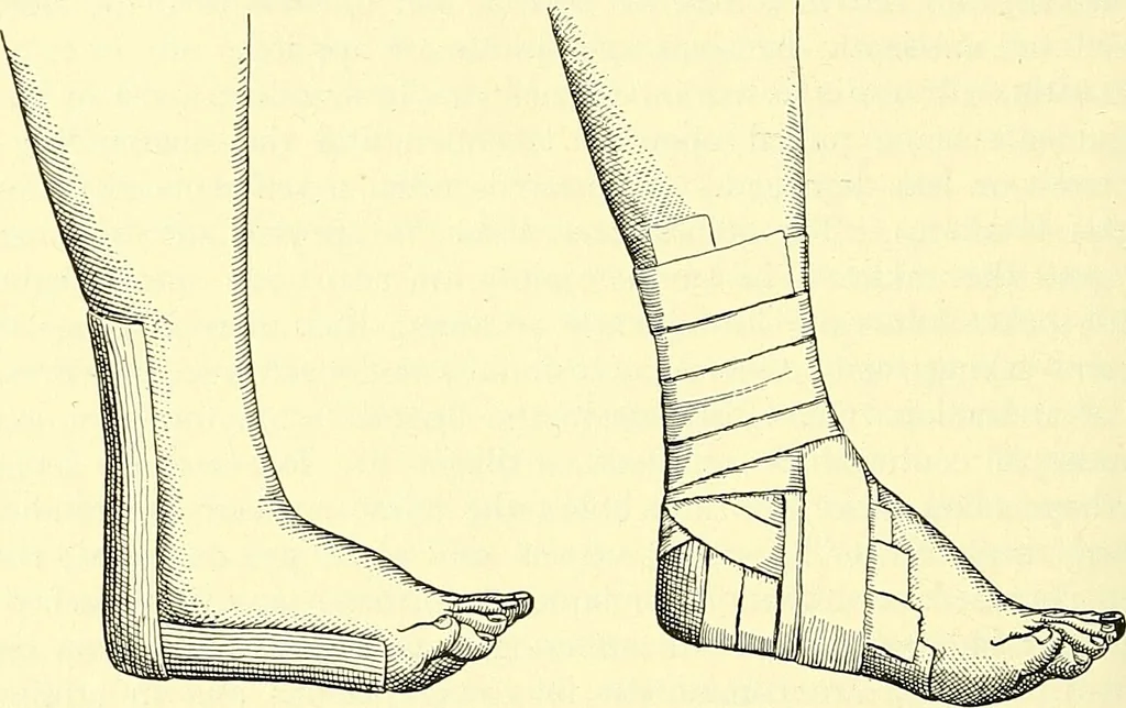 An illustration from Modern surgery, general and operative / by John Chalmers Da Costa., 1907, leaf 592