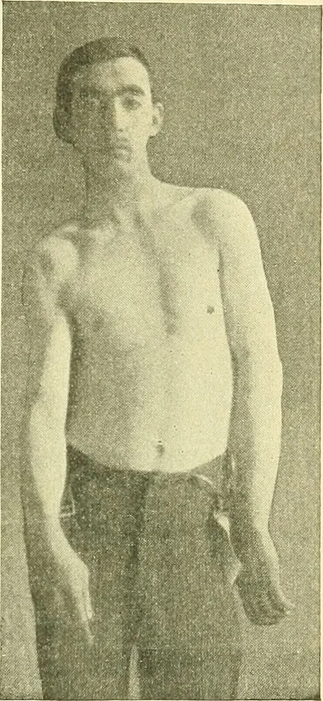 An illustration from Modern surgery, general and operative / by John Chalmers Da Costa., 1907, leaf 605