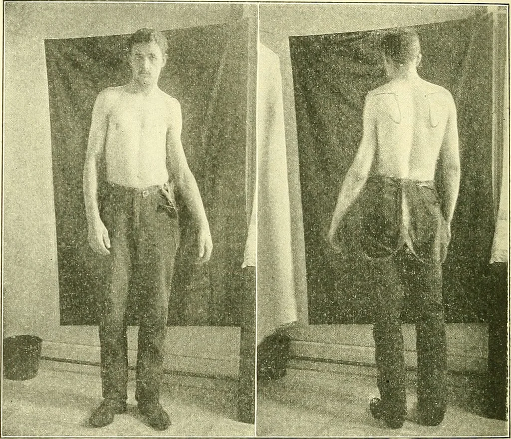 An illustration from Modern surgery, general and operative / by John Chalmers Da Costa., 1907, leaf 606