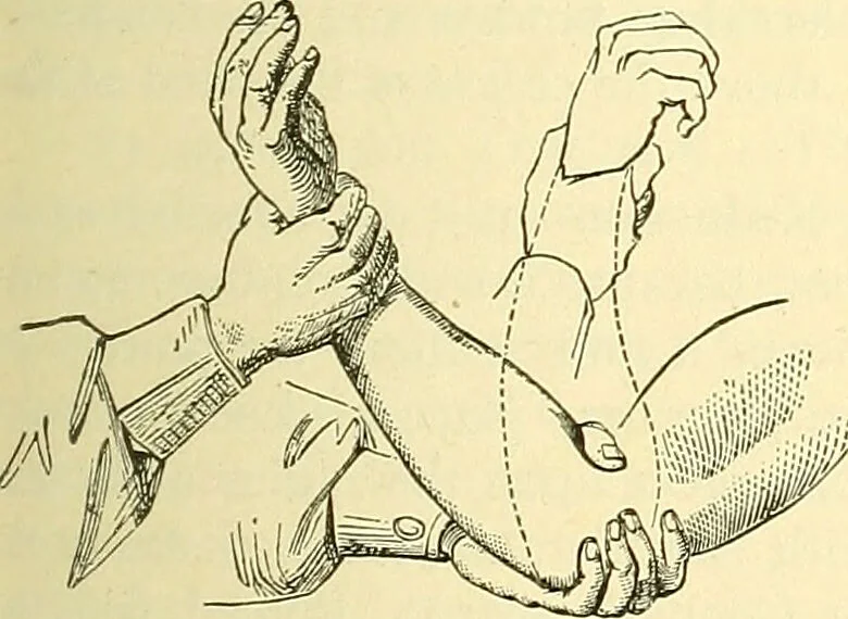 An illustration from Modern surgery, general and operative / by John Chalmers Da Costa., 1907, leaf 611