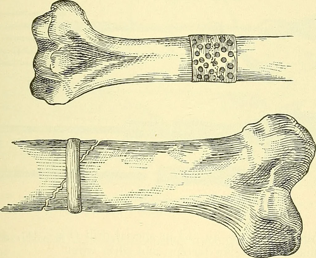 An illustration from Modern surgery, general and operative / by John Chalmers Da Costa., 1907, leaf 633