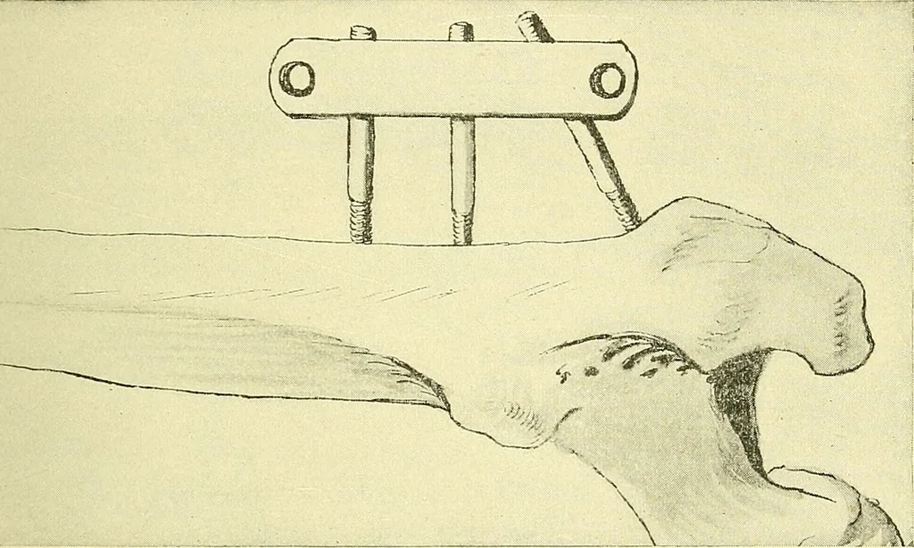 An illustration from Modern surgery, general and operative / by John Chalmers Da Costa., 1907, leaf 635