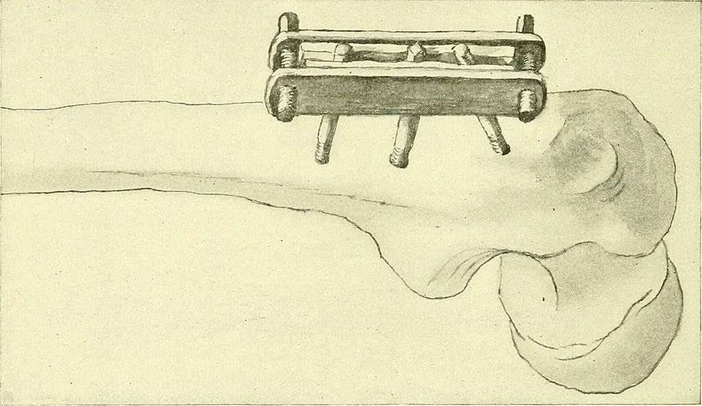 An illustration from Modern surgery, general and operative / by John Chalmers Da Costa., 1907, leaf 636