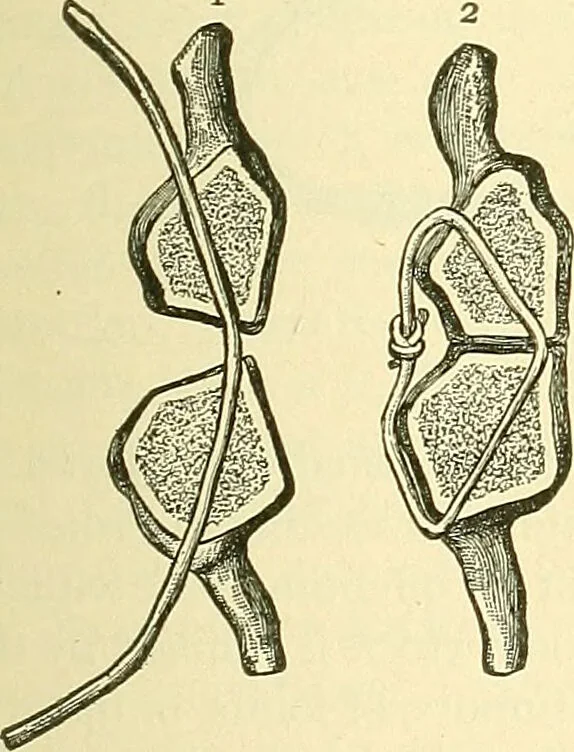 An illustration from Modern surgery, general and operative / by John Chalmers Da Costa., 1907, leaf 637