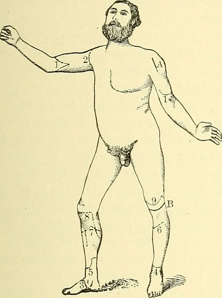 An illustration from Modern surgery, general and operative / by John Chalmers Da Costa., 1907, leaf 641