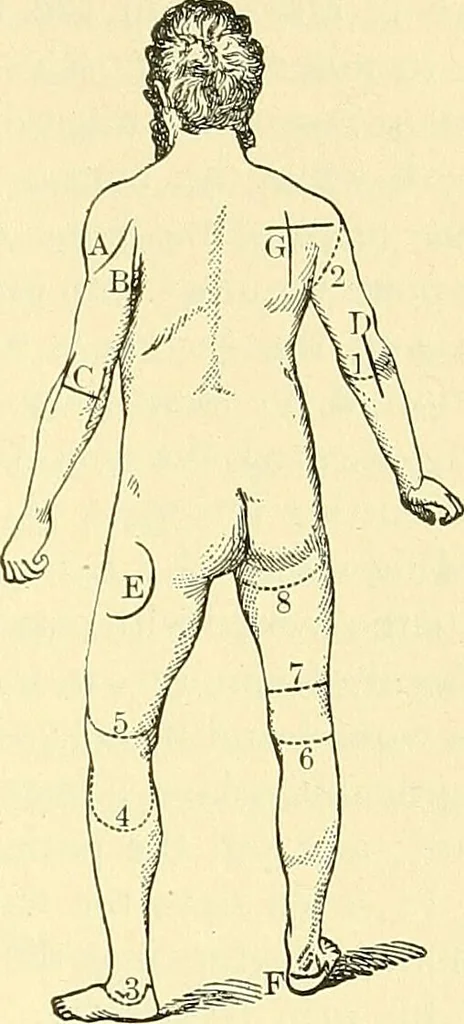 An illustration from Modern surgery, general and operative / by John Chalmers Da Costa., 1907, leaf 641