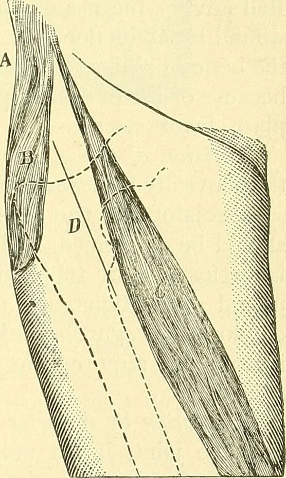 An illustration from Modern surgery, general and operative / by John Chalmers Da Costa., 1907, leaf 645