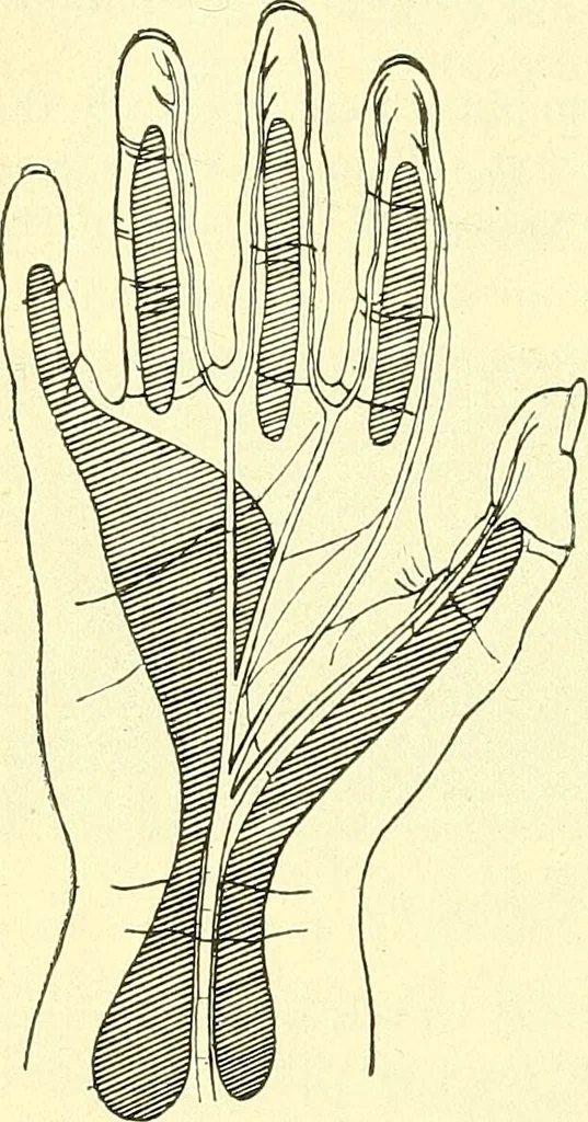 An illustration from Modern surgery, general and operative / by John Chalmers Da Costa., 1907, leaf 664