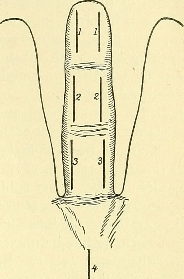 An illustration from Modern surgery, general and operative / by John Chalmers Da Costa., 1907, leaf 667