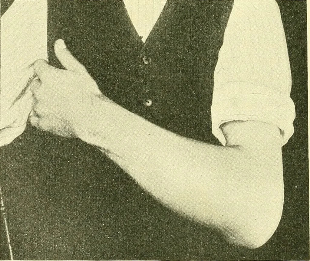 An illustration from Modern surgery, general and operative / by John Chalmers Da Costa., 1907, leaf 670