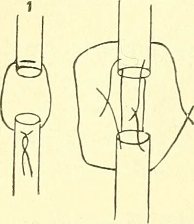 An illustration from Modern surgery, general and operative / by John Chalmers Da Costa., 1907, leaf 674