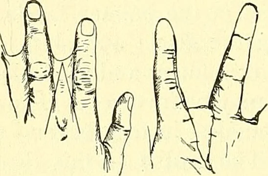 An illustration from Modern surgery, general and operative / by John Chalmers Da Costa., 1907, leaf 678